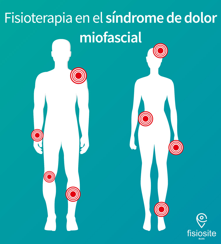 Fisioterapia en el síndrome de dolor miofascial Fisiosite